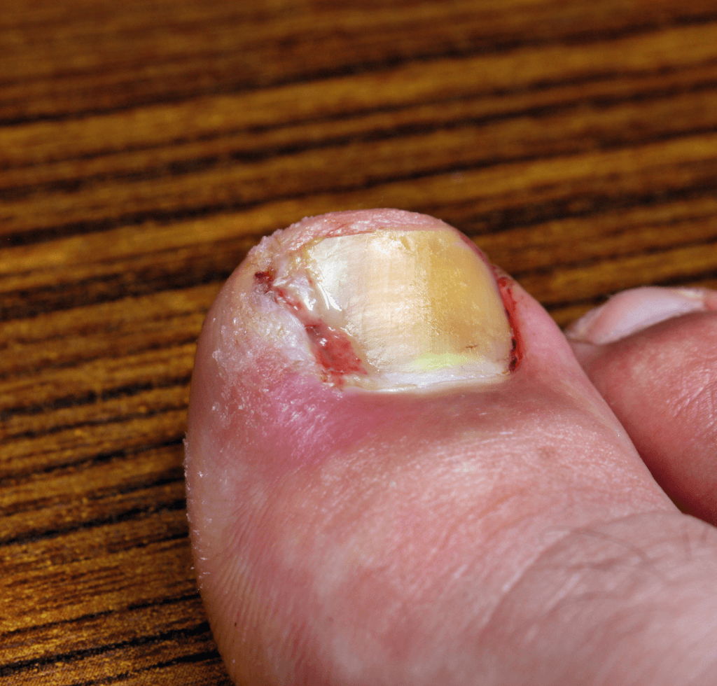Alarming Signs of Diabetes Foot Complications