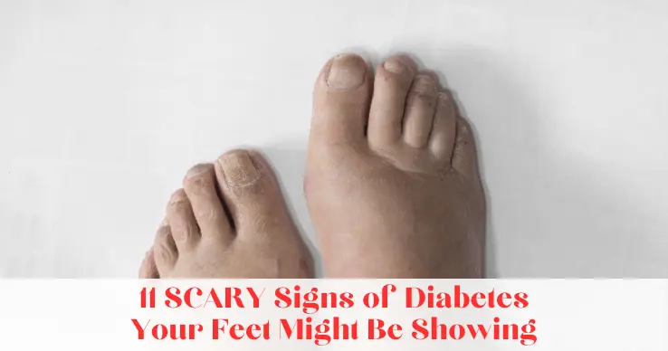 Diabetes Signs in Feet